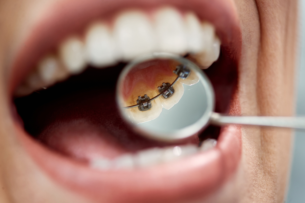 braces