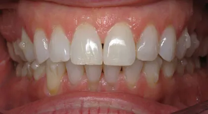 Invisalign Attachments: Why Are They Needed?