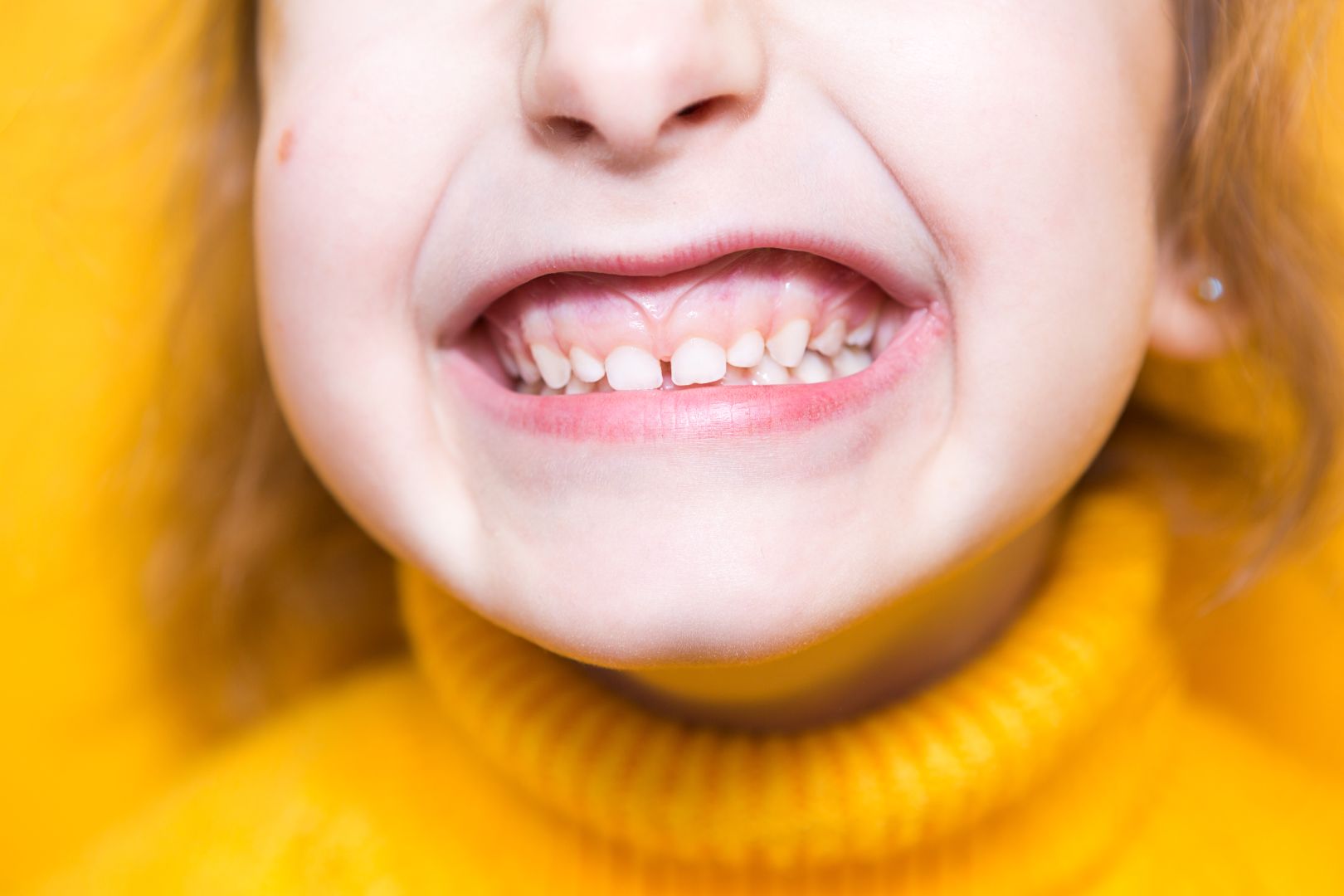 overbite