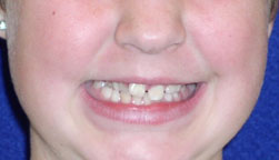 Child's smile with crossbite requiring early orthodontic treatment