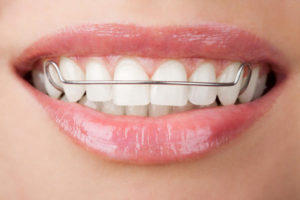 Removable Retainers