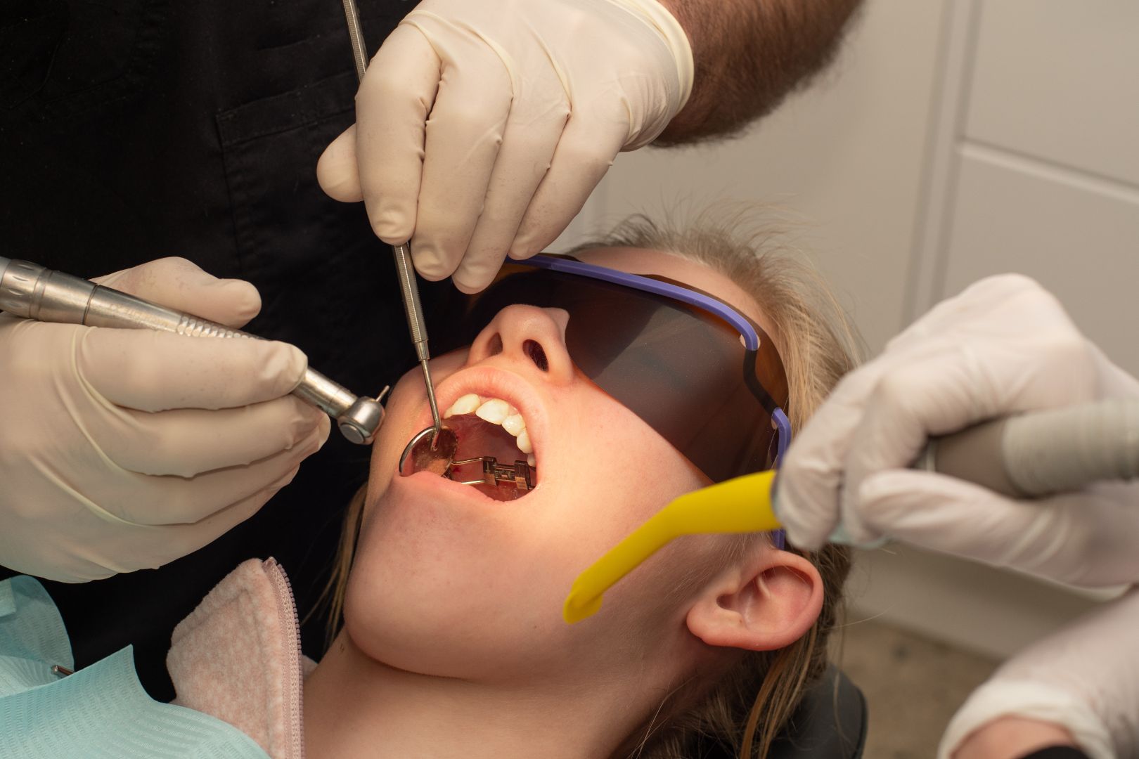 palate expander