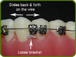 Loose bracket on braces