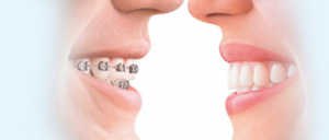 Cater Galante Invisalign Teen® vs Traditional Braces