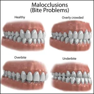 Cater Galante Malocclusions